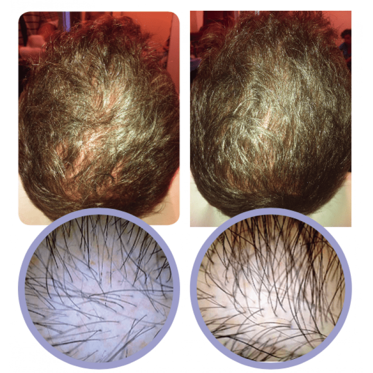 Behandling av håravfall före och efter